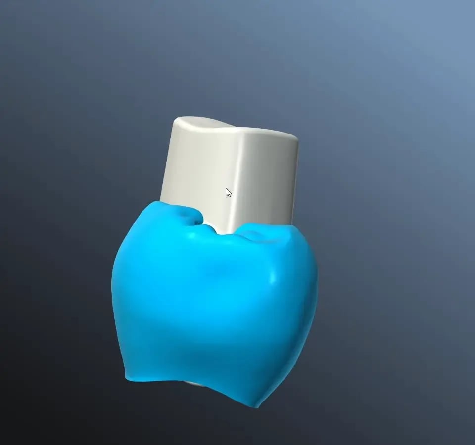 Aligned crown and abutment in the 3D viewer