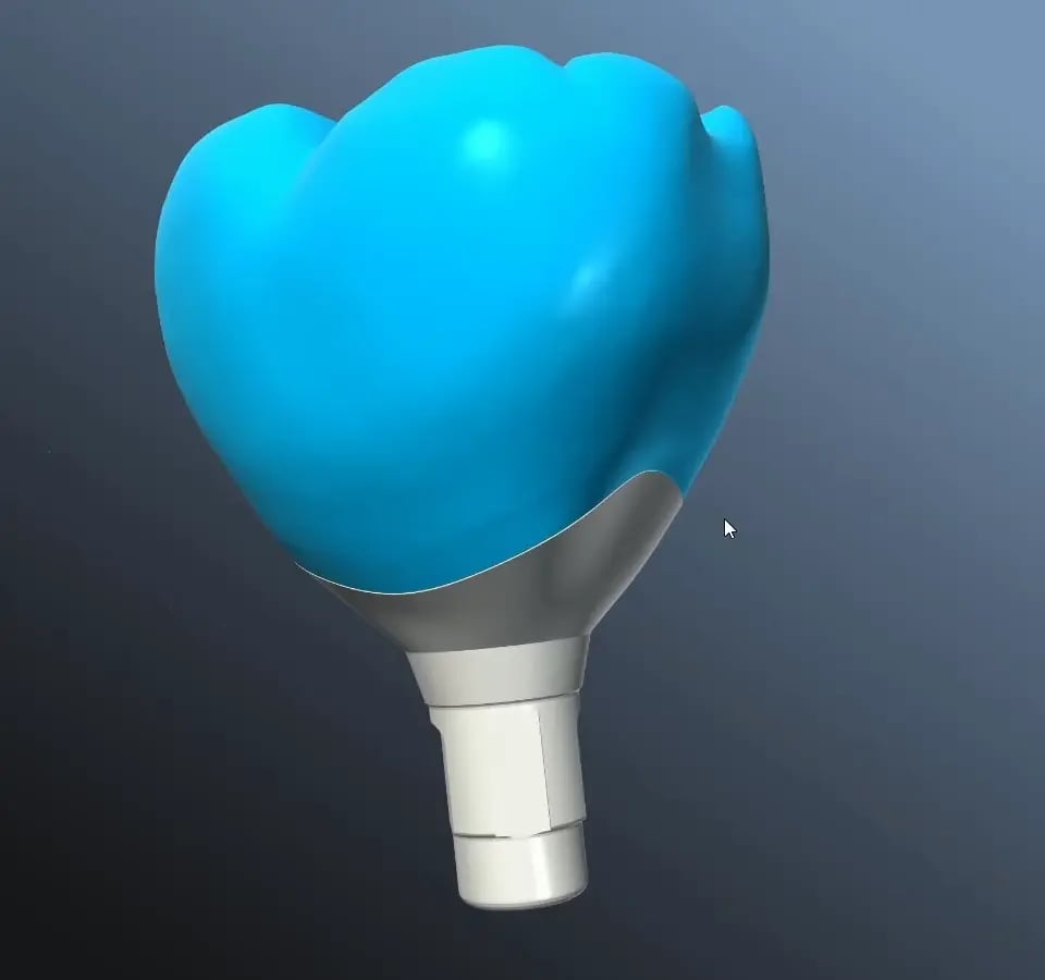 Cyan crown and abutment shown together in the DentSolver CoDesign result viewer