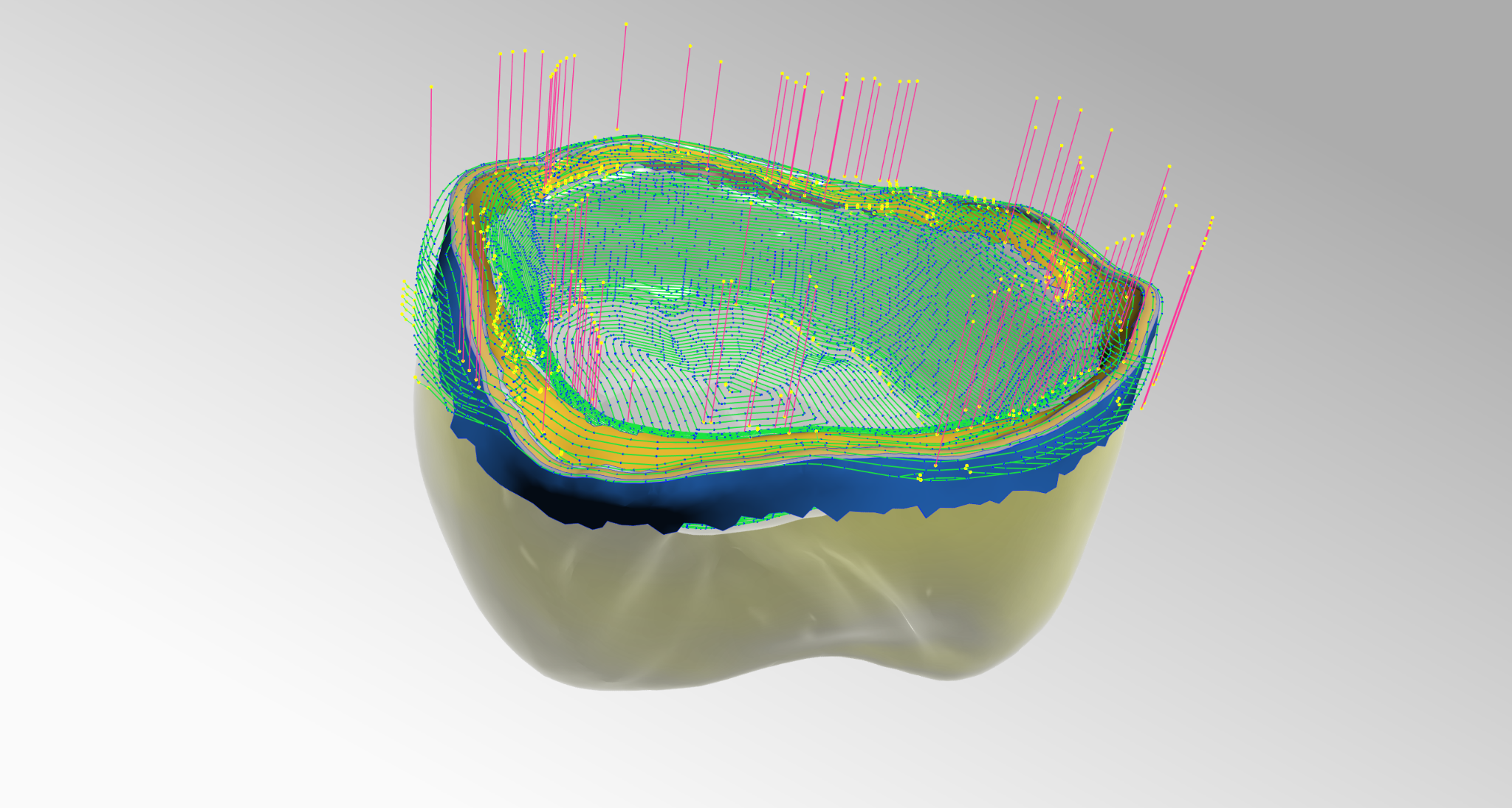 Crown/coping workflow example with toolpath overlay